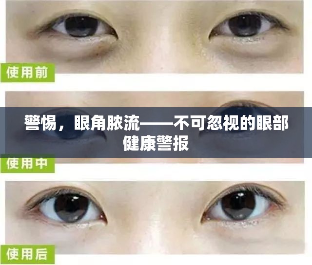 警惕，眼角膿流——不可忽視的眼部健康警報(bào)