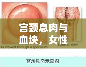 宮頸息肉與血塊，女性健康的隱形警報