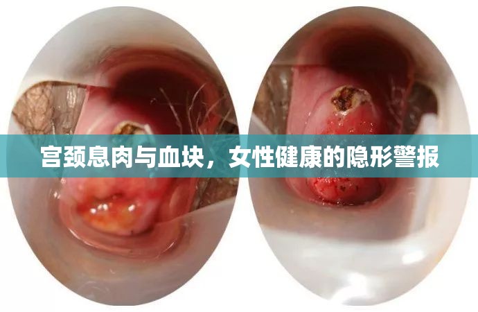 宮頸息肉與血塊，女性健康的隱形警報