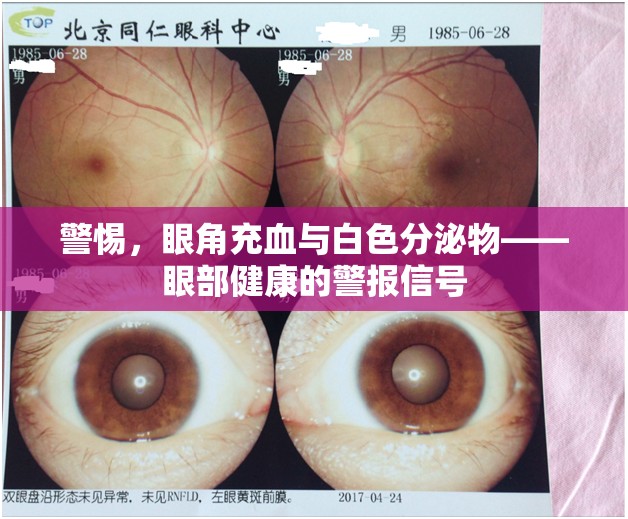警惕，眼角充血與白色分泌物——眼部健康的警報信號