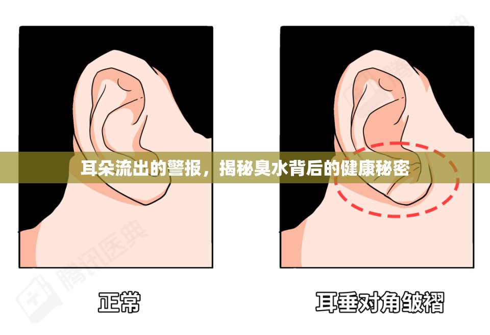 耳朵流出的警報(bào)，揭秘臭水背后的健康秘密