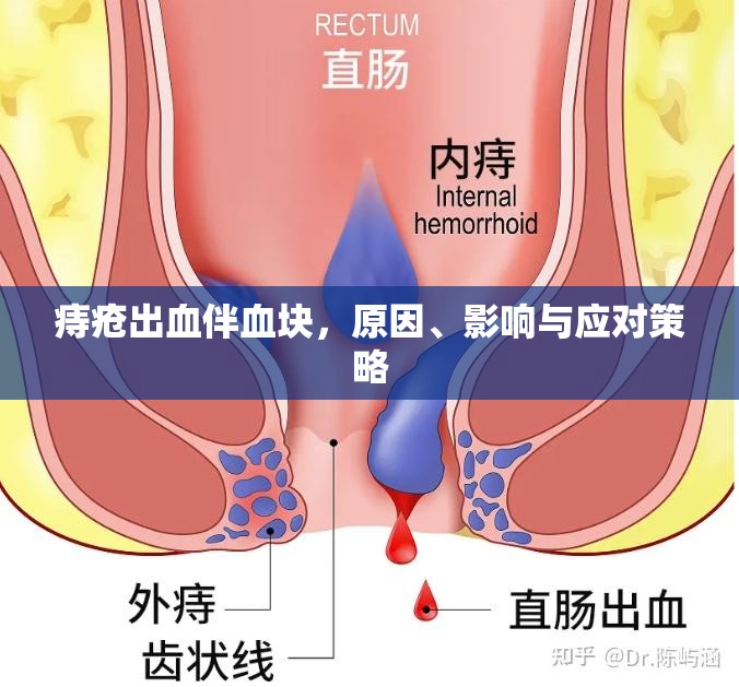 痔瘡出血伴血塊，原因、影響與應對策略