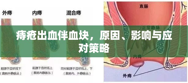 痔瘡出血伴血塊，原因、影響與應對策略