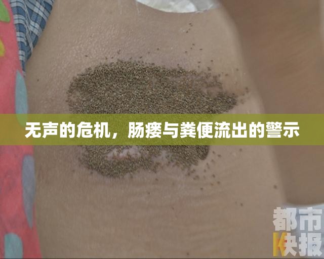 無聲的危機，腸瘺與糞便流出的警示