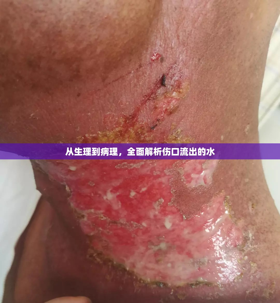 從生理到病理，全面解析傷口流出的水