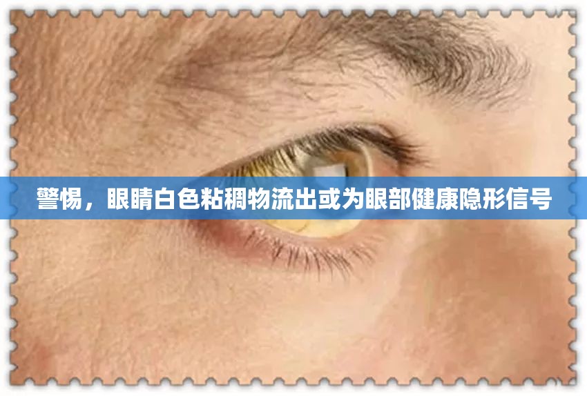 警惕，眼睛白色粘稠物流出或?yàn)檠鄄拷】惦[形信號(hào)
