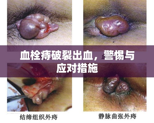 血栓痔破裂出血，警惕與應(yīng)對措施