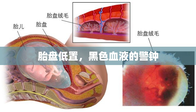 胎盤低置，黑色血液的警鐘