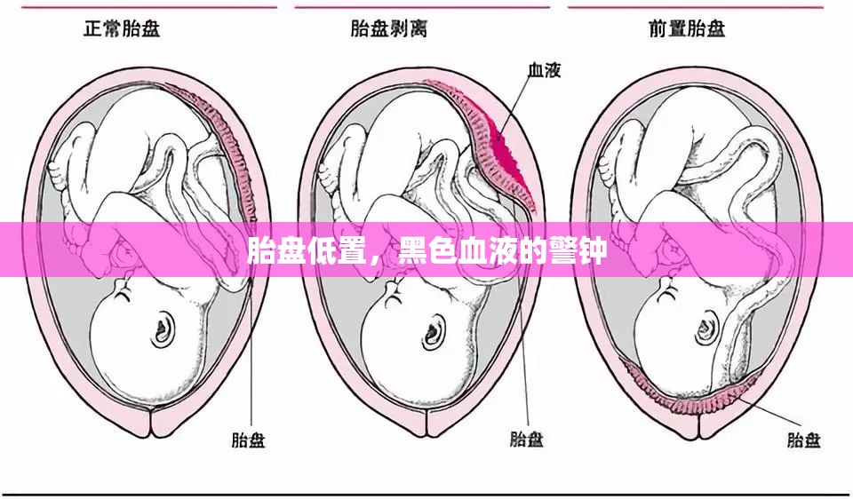 胎盤低置，黑色血液的警鐘