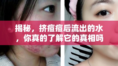 揭秘，擠痘痘后流出的水，你真的了解它的真相嗎？