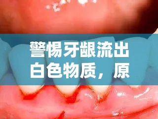 警惕牙齦流出白色物質(zhì)，原因、癥狀與預(yù)防措施