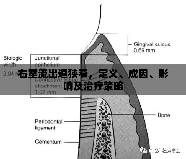 右室流出道狹窄，定義、成因、影響及治療策略