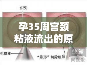孕35周宮頸粘液流出的原因及注意事項(xiàng)