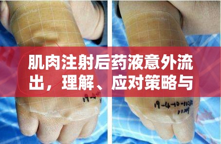 肌肉注射后藥液意外流出，理解、應(yīng)對(duì)策略與預(yù)防措施
