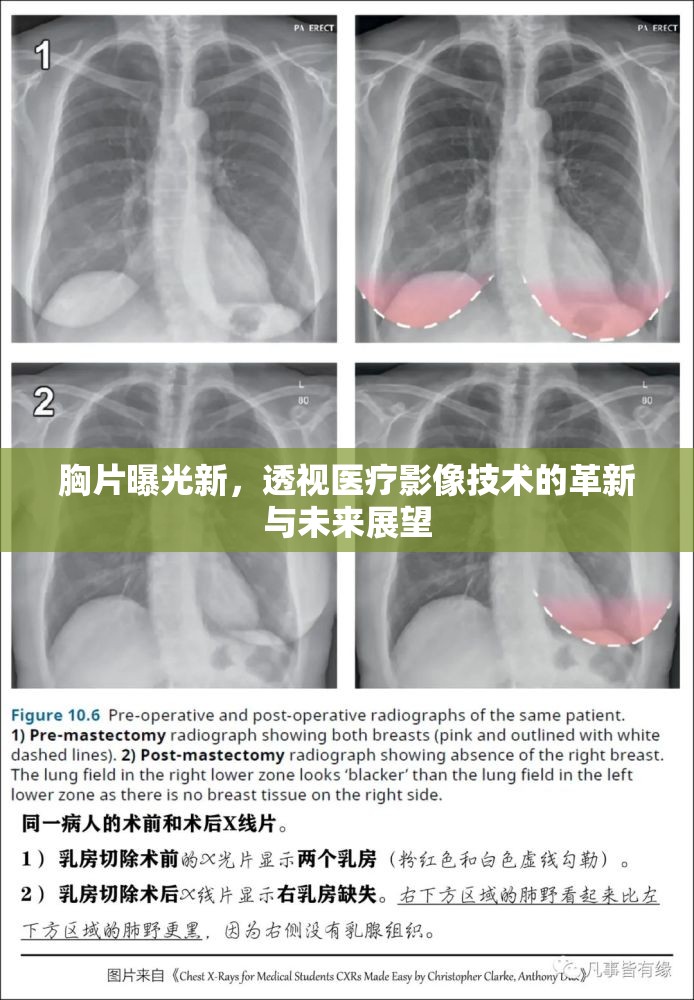 胸片曝光新，透視醫(yī)療影像技術(shù)的革新與未來(lái)展望
