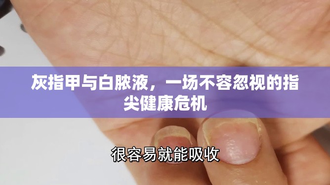 灰指甲與白膿液，一場不容忽視的指尖健康危機