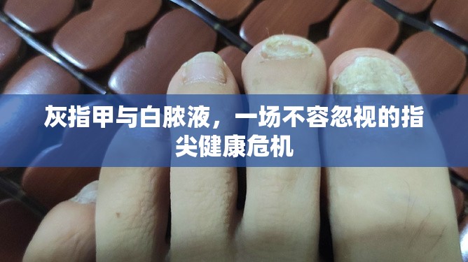 灰指甲與白膿液，一場不容忽視的指尖健康危機