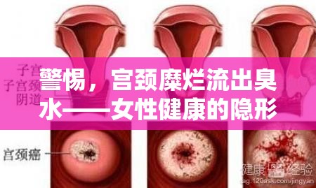 警惕，宮頸糜爛流出臭水——女性健康的隱形殺手