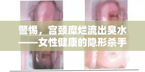 警惕，宮頸糜爛流出臭水——女性健康的隱形殺手