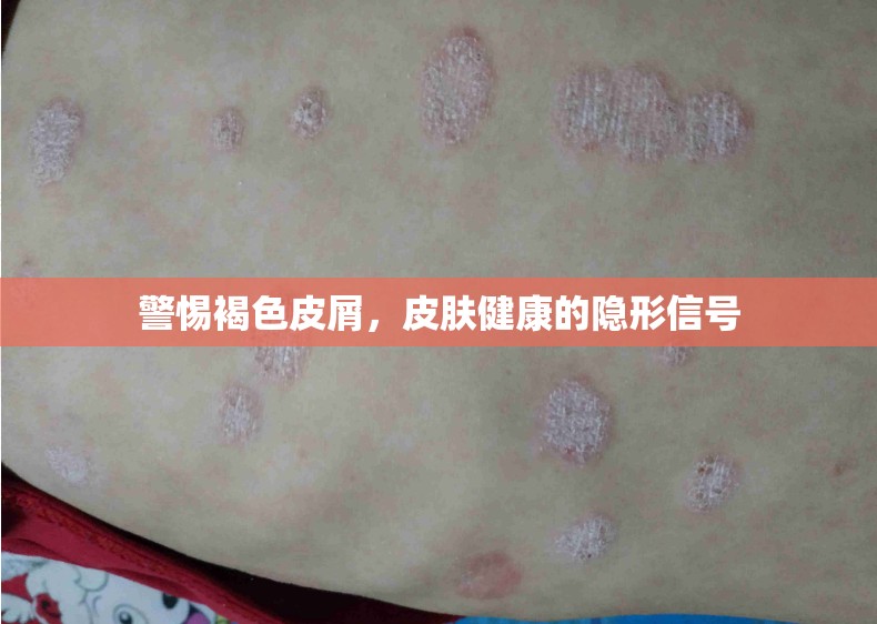 警惕褐色皮屑，皮膚健康的隱形信號