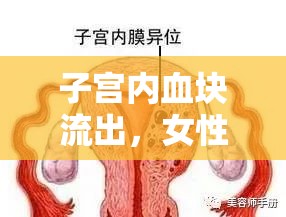 子宮內血塊流出，女性健康的緊急警報