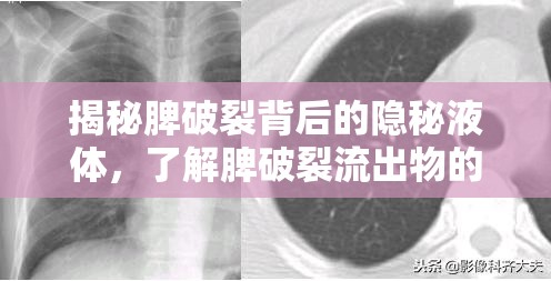 揭秘脾破裂背后的隱秘液體，了解脾破裂流出物的重要性與應(yīng)對措施