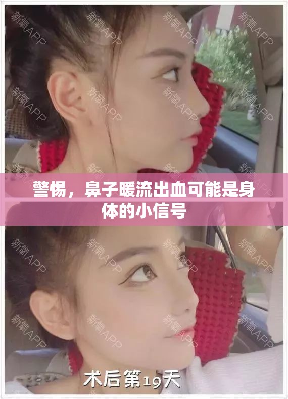 警惕，鼻子暖流出血可能是身體的小信號