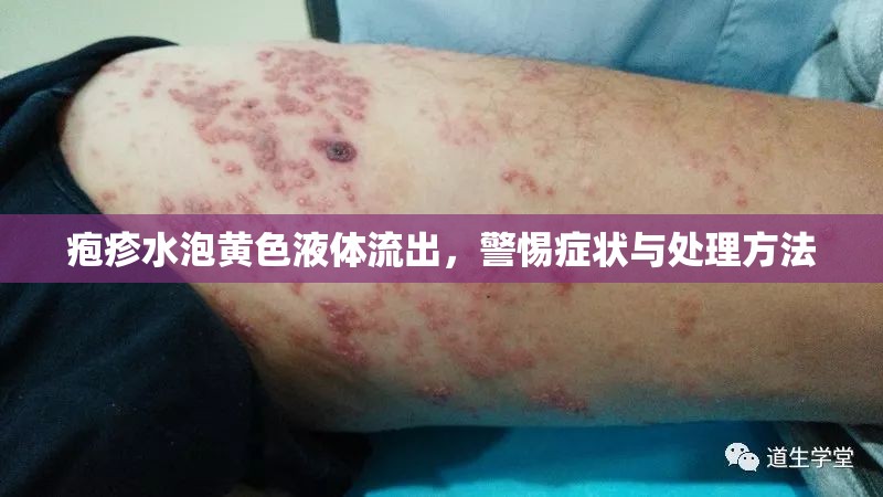 皰疹水泡黃色液體流出，警惕癥狀與處理方法