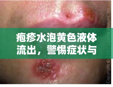 皰疹水泡黃色液體流出，警惕癥狀與處理方法