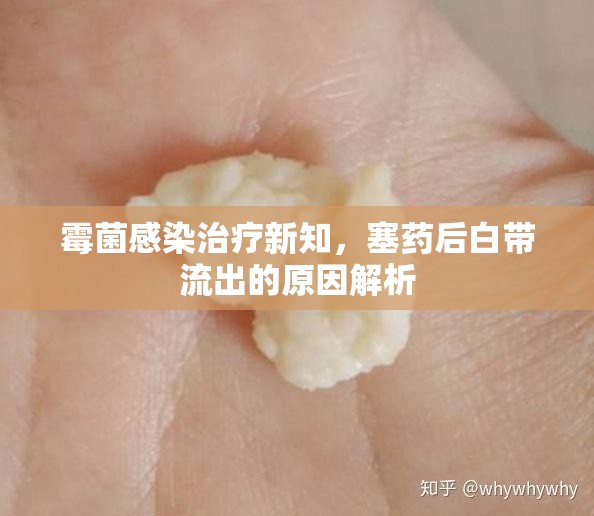 霉菌感染治療新知，塞藥后白帶流出的原因解析