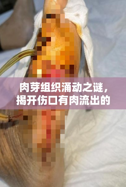 肉芽組織涌動之謎，揭開傷口有肉流出的真相