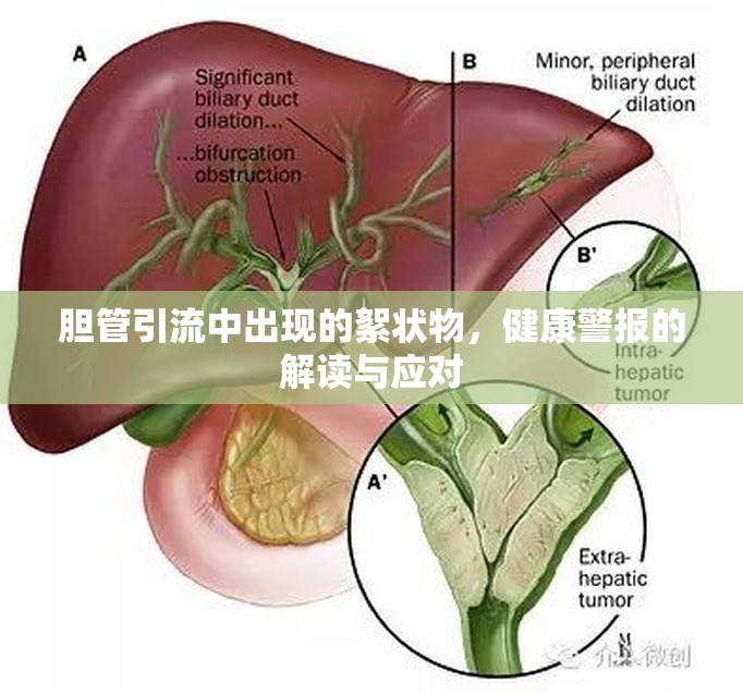 膽管引流中出現(xiàn)的絮狀物，健康警報(bào)的解讀與應(yīng)對