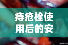痔瘡栓使用后的安心疑問，是否會融化流出？