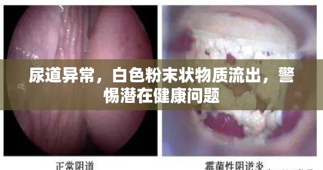 尿道異常，白色粉末狀物質(zhì)流出，警惕潛在健康問題
