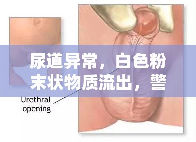 尿道異常，白色粉末狀物質(zhì)流出，警惕潛在健康問題