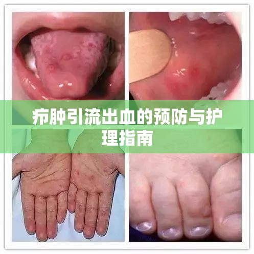 癤腫引流出血的預(yù)防與護(hù)理指南