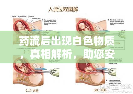 藥流后出現(xiàn)白色物質(zhì)，真相解析，助您安心面對(duì)