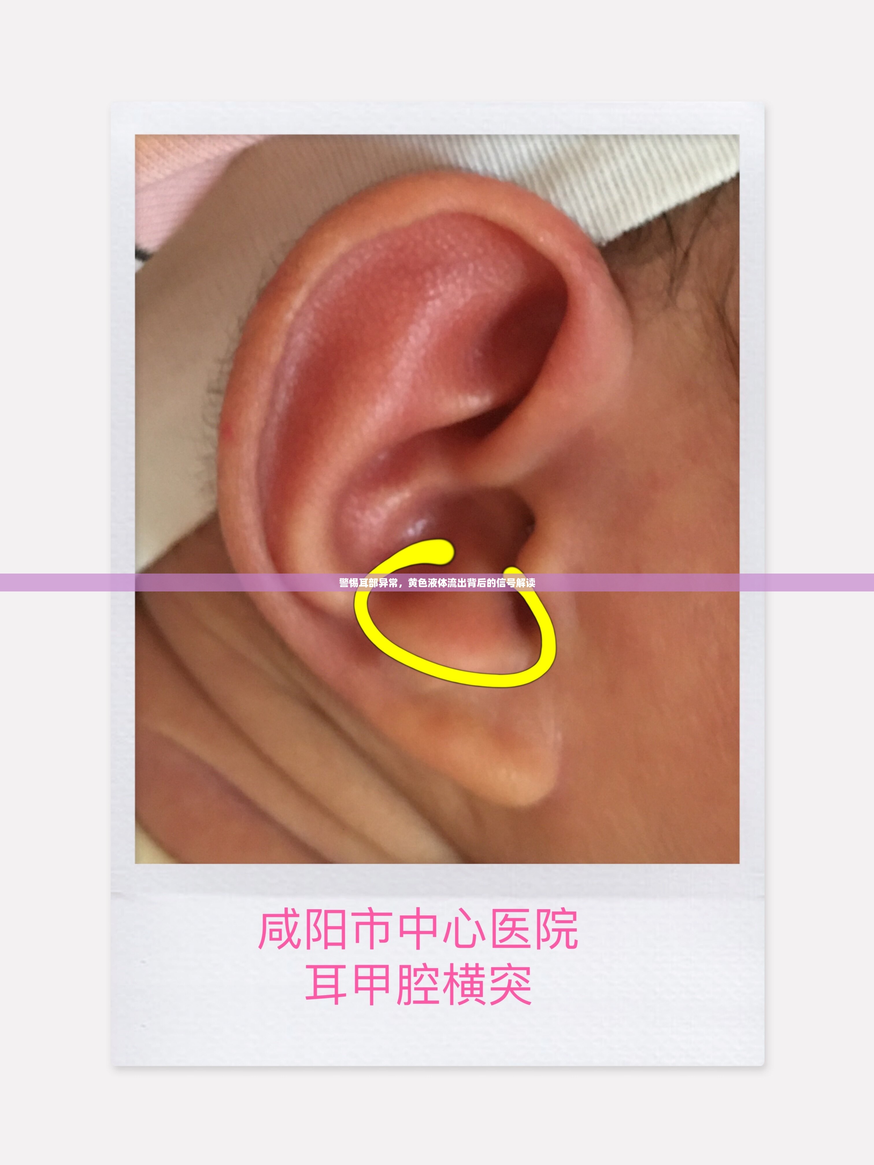 警惕耳部異常，黃色液體流出背后的信號解讀