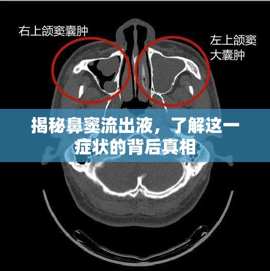 揭秘鼻竇流出液，了解這一癥狀的背后真相
