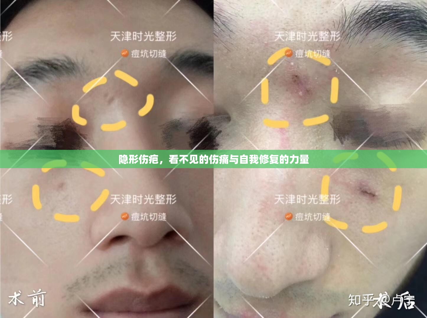 隱形傷疤，看不見的傷痛與自我修復(fù)的力量
