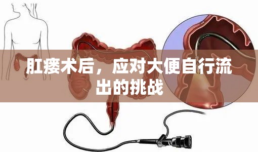 肛瘺術(shù)后，應(yīng)對大便自行流出的挑戰(zhàn)