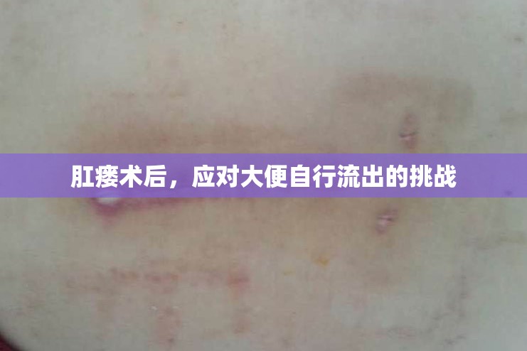 肛瘺術(shù)后，應(yīng)對大便自行流出的挑戰(zhàn)