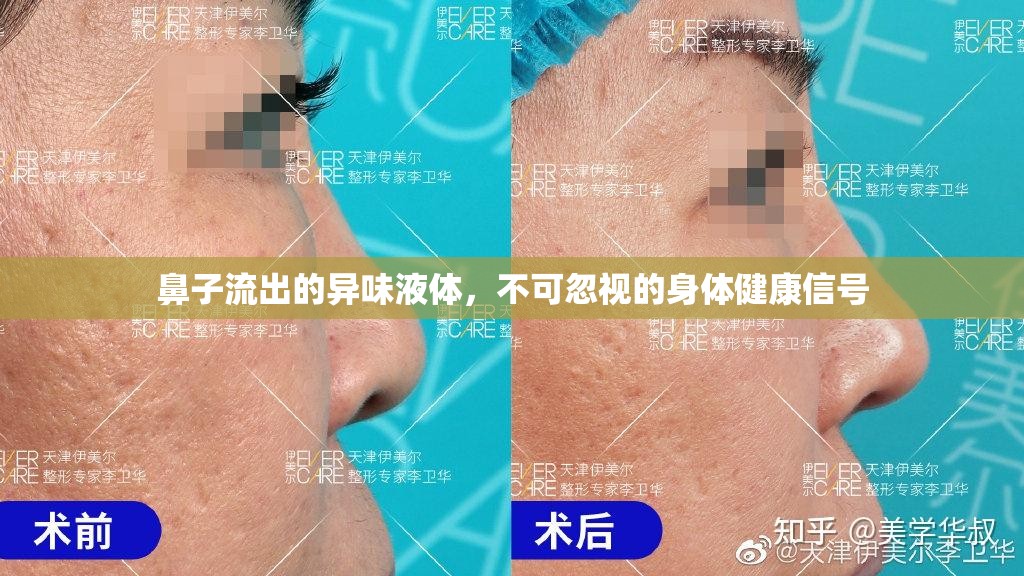 鼻子流出的異味液體，不可忽視的身體健康信號