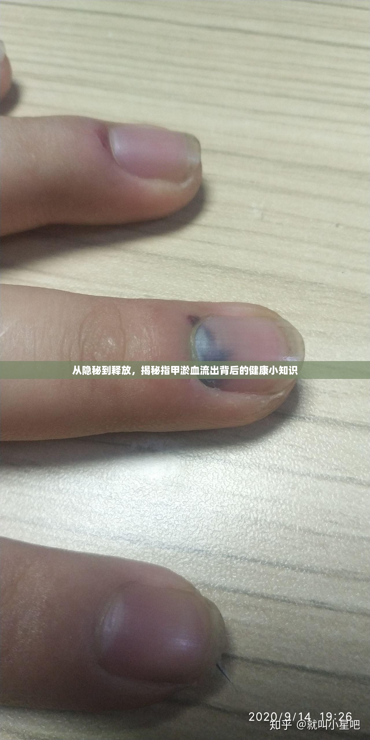 從隱秘到釋放，揭秘指甲淤血流出背后的健康小知識