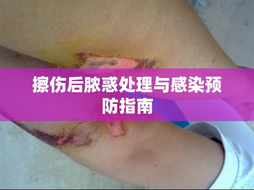 擦傷后膿惑處理與感染預(yù)防指南