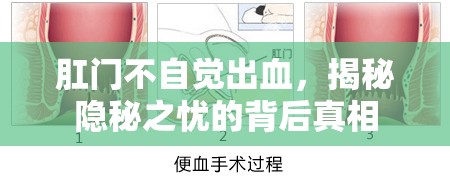 肛門不自覺出血，揭秘隱秘之憂的背后真相