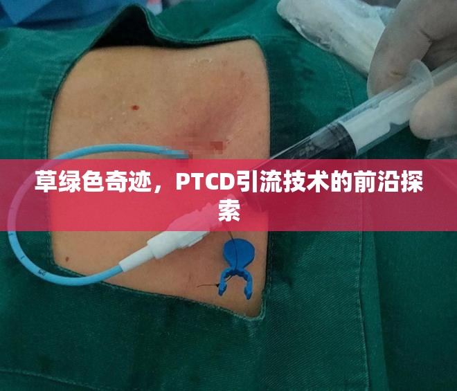 草綠色奇跡，PTCD引流技術(shù)的前沿探索