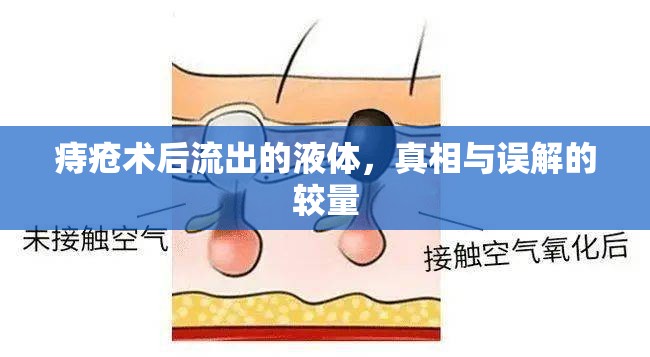 痔瘡術后流出的液體，真相與誤解的較量