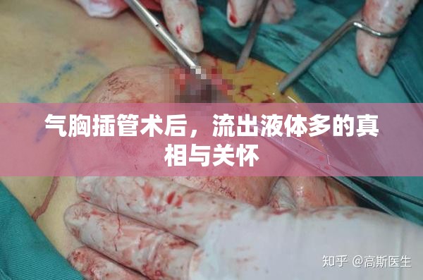 氣胸插管術后，流出液體多的真相與關懷