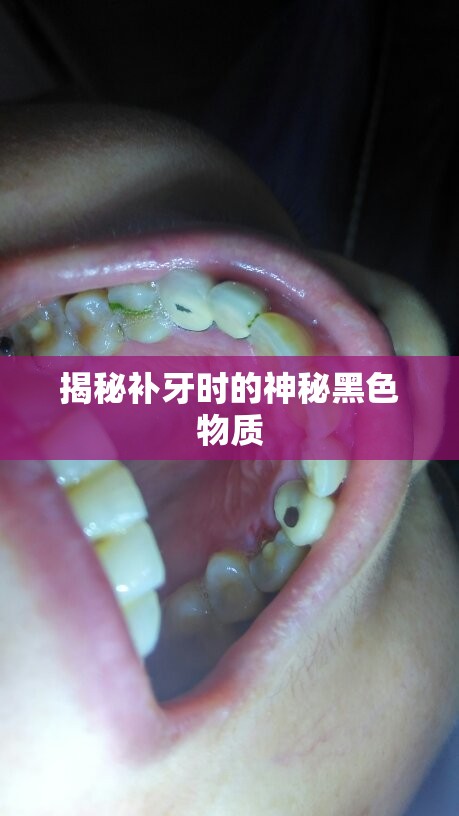揭秘補牙時的神秘黑色物質(zhì)